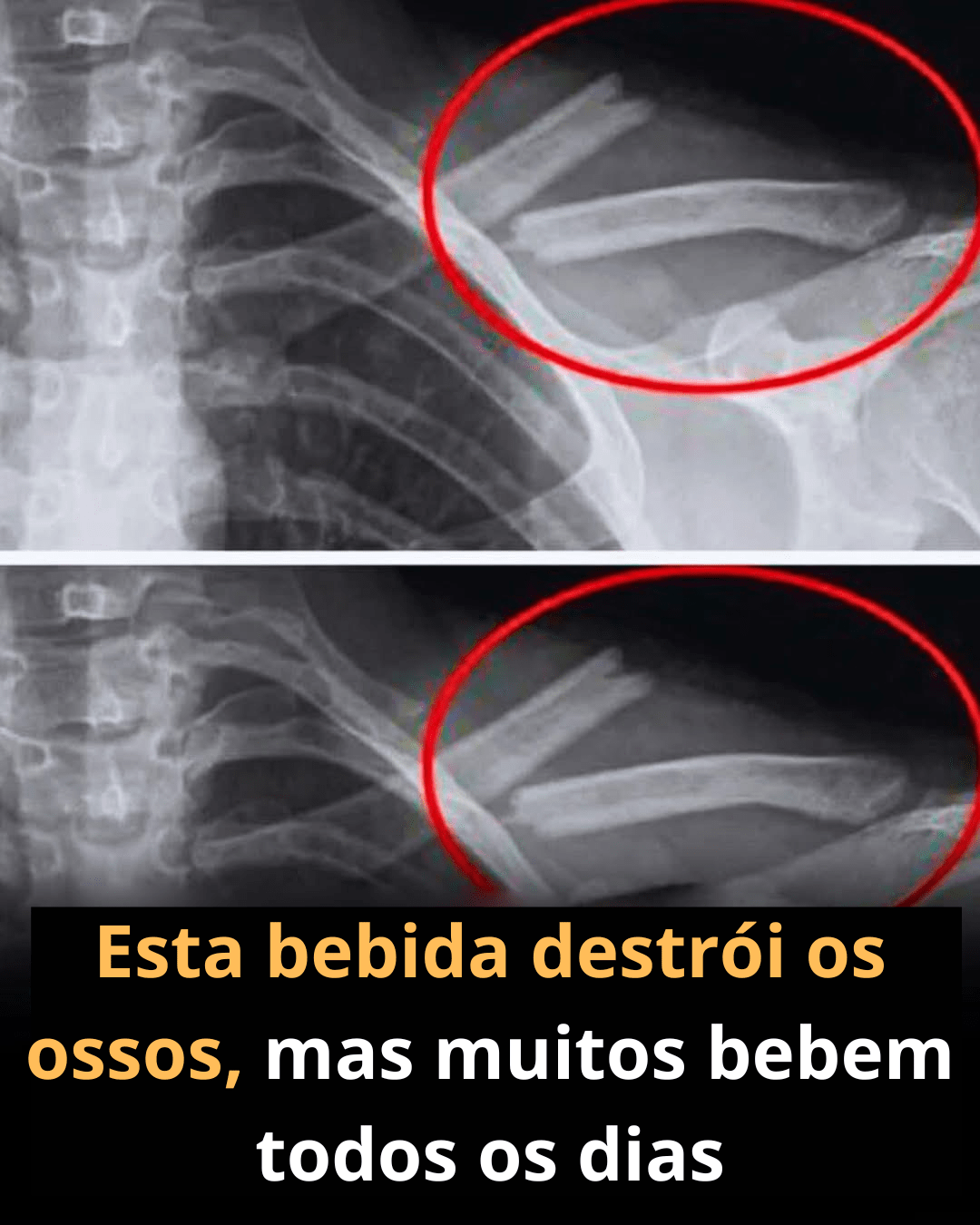 Refrigerante e Ossos: Risco à Sua Saúde Óssea