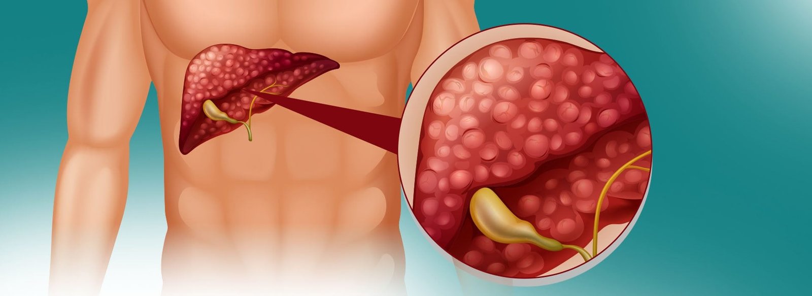 Vesícula Biliar Removida: Adaptação e Cuidados Pós-Cirurgia