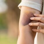 Leucemia: Sintomas, Tipos e Avanços no Tratamento Atual Leucemia: Sintomas, Tipos e Avanços no Tratamento Atual