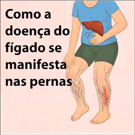 Sua perna está te dando sinais claros de que seu fígado precisa de ajuda. Você consegue identificá-los?